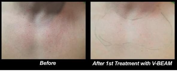 Wondering "what can I do for rosacea?" After one session with Dr. U and the V-BEAM laser this patient already noticed significant progress.*