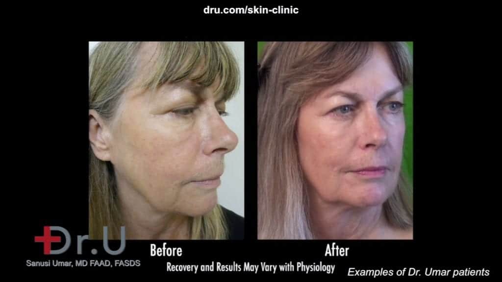 Non surgical liquid facelift using Radiesse and botox by Dr U prevents the need for a facelift