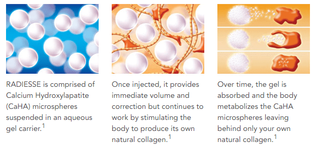Radiesse provides immediate correction and continues to work by allowing the body to produce its own natural collagen. (Image found at http://www.radiesse.com/ ) *