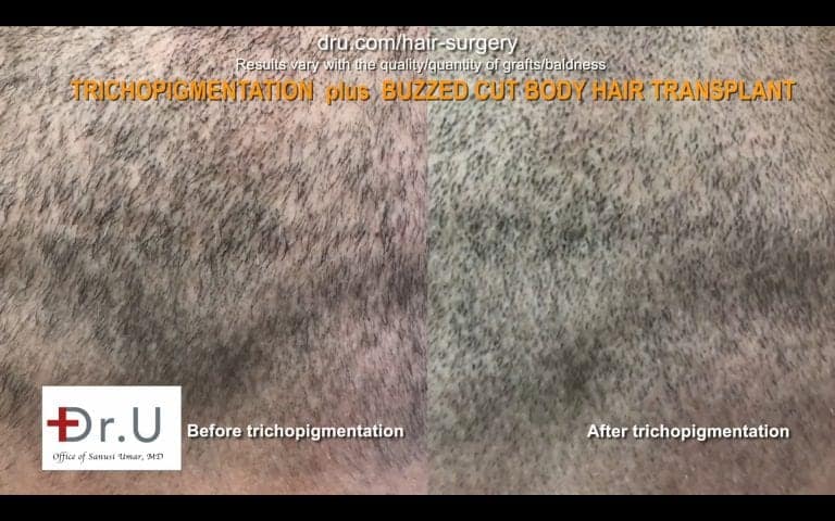 Hair transplant scar cover up by DrUGraft BHT & SMP.