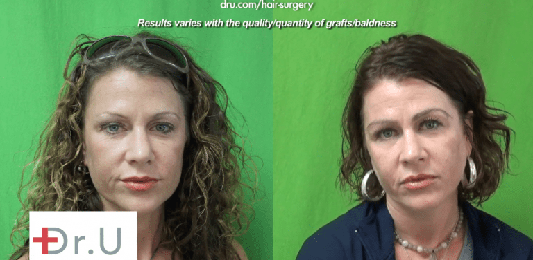 Manhattan Beach patient before and after her eyebrow transplant which achieved the thick shaped eyebrows that she hoped for
