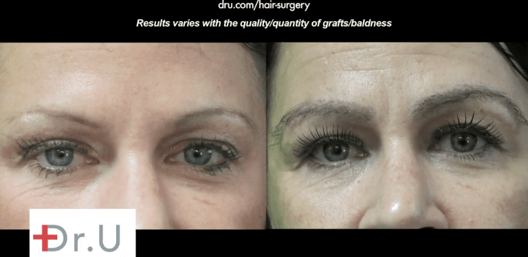 Before and after eyebrow restoration surgery with nape hair showing the thick shaped eyebrows inspired by Kim Kardashian