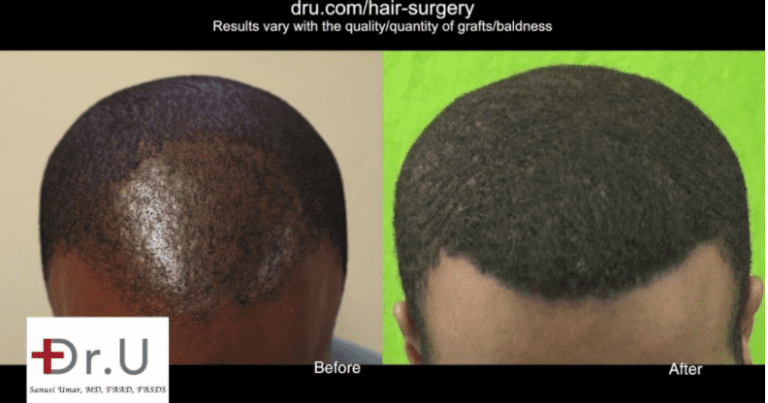 Black celebrity hair loss solution with Dr.UPunch Curl