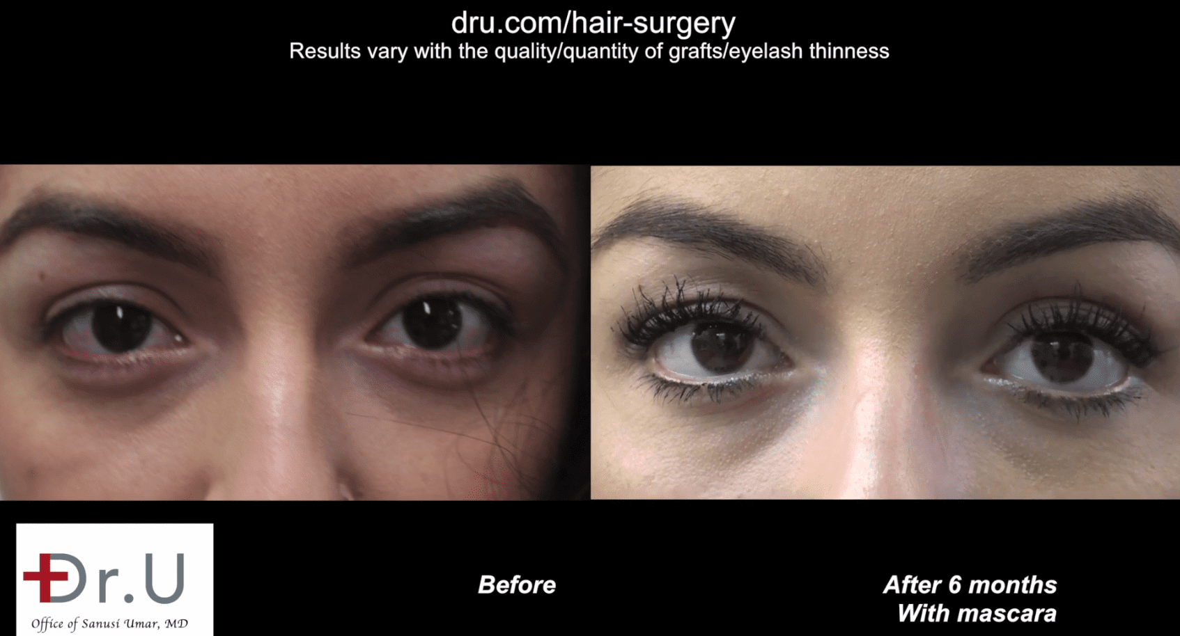 The patient is able to curl and style her eyelashes 6 months after her eyelash hair transplantation.