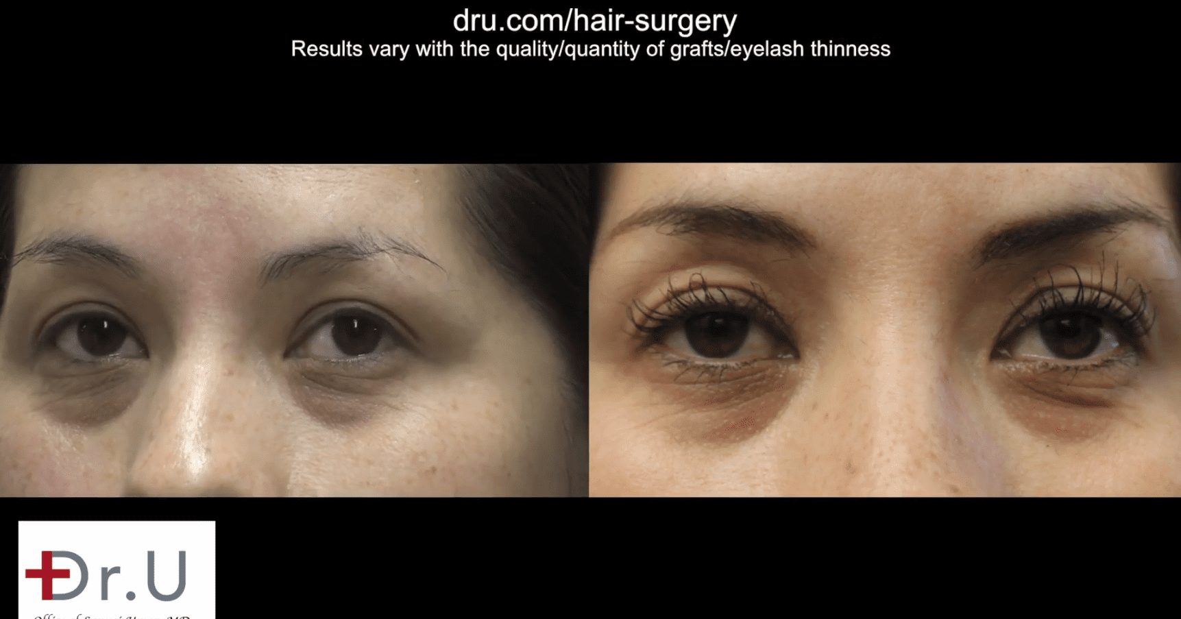 This patient got Longer thicker eyelashes after Dr.UGraft eyelash extension surgery This patient got longer thicker eyelashes after Dr.UGraft eyelash extension surgery