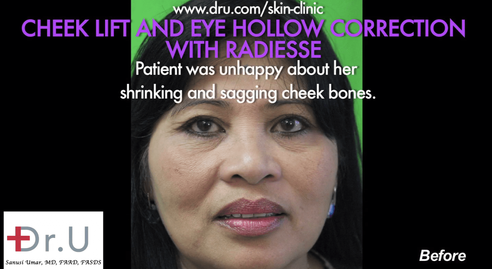 The patient’s picture before Dr. U performed a non surgical cheek lift.