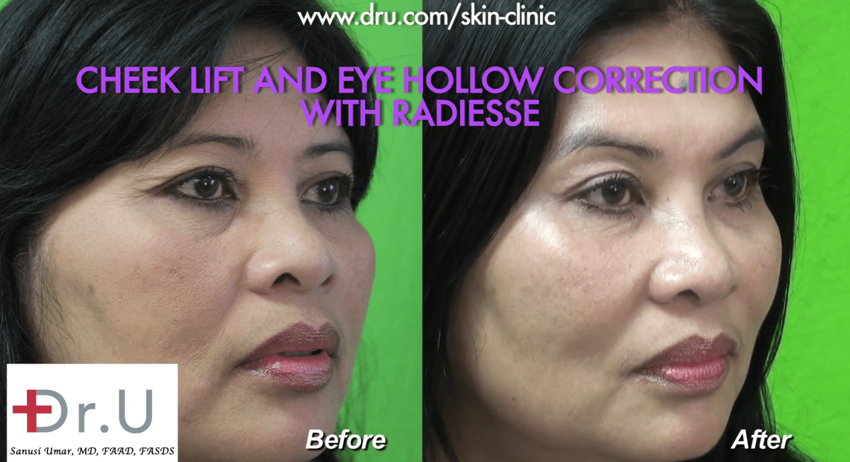 The patient before and after Dr. U performed a cheek lift without surgery using The patient before and after Dr. U performed a non surgical cheek lift and hollow eye treatment using Radiesse.*