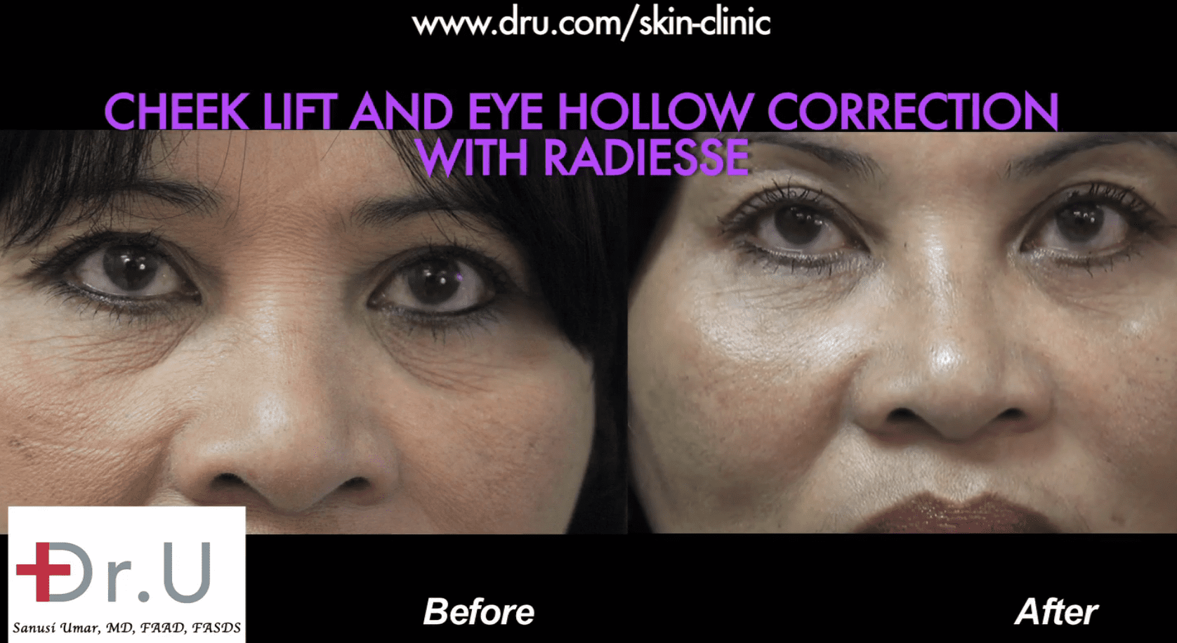 Under eye hollow filler before and after photos using Radiesse. Under eye hollow filler before and after photos using Radiesse.*