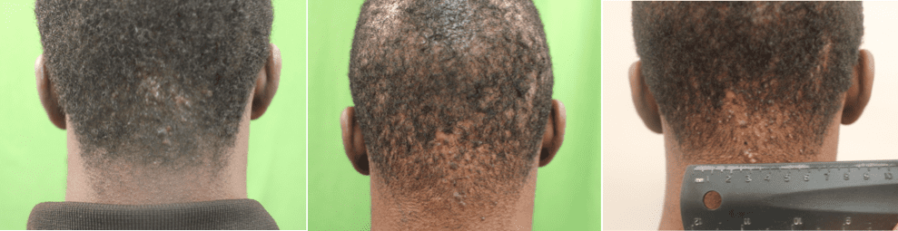 Before and after topical steroids (steroid creams) to treat razor bumps on the back of the head, then again after six months when the AKN returned.* Before and after topical steroids (steroid creams) to treat razor bumps on the back of the head, then again after six months when the AKN returned.*