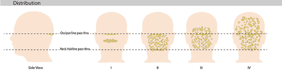 Stages I or II bumps on back of head best for surgery. For a single large bump on the back of the head, surgical removal is still possible.* 