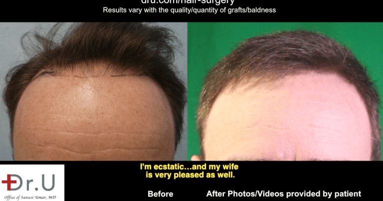  In order to restore and refine the hairline in his Studio City patient, Dr. Umar harvested donor hair from both the head and body.