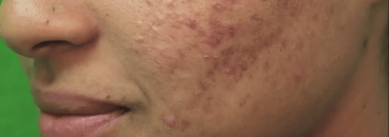 Patient who wants to improve acne scars on her face