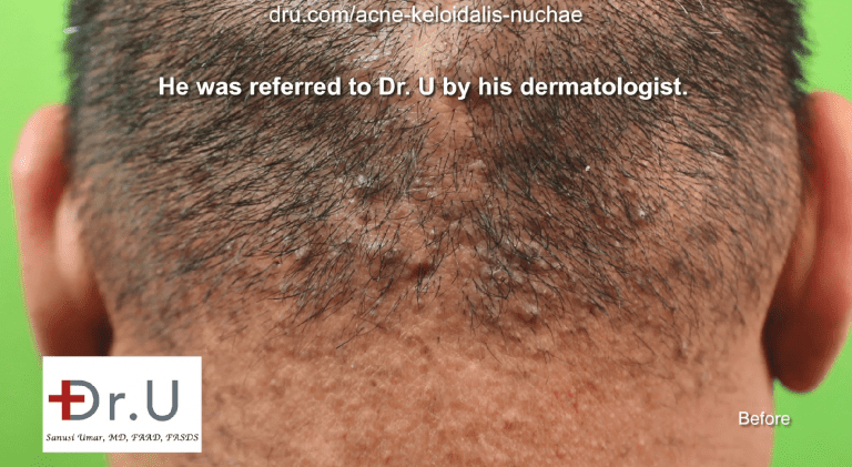 This patient was referred to the Dr.U Skin Clinic by his dermatologist for an acne keloidalis nuchae medical treatment. His AKN was still in the papule stage, which qualified him for non-surgical treatment of acne keloidalis nuchae.