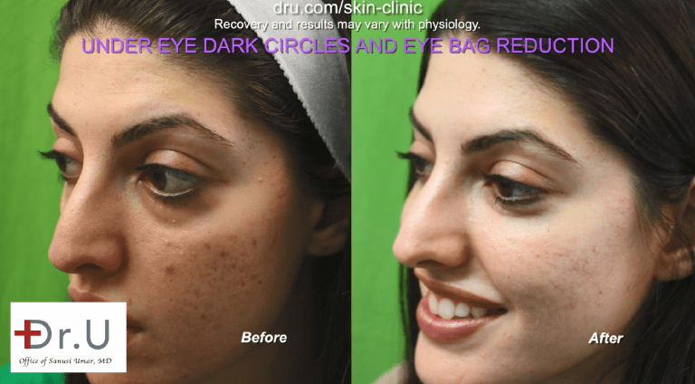 The calcium particles within Radiesse provide volume and support in the injected area, allowing under eye bags to be lifted toward the tear trough and reshaped to be in line with the face. This creates the appearance of an eye bag reduction.