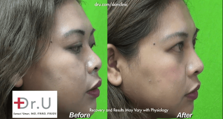 Profile view of low nose bridge seen before and after treatment with Radiesse* Profile view of low nose bridge seen before and after treatment with Radiesse*