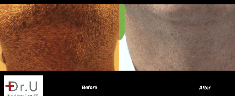 Cosmetically insignificant scarring of beard donor area after Dr.UGraft FUE corrective hair surgery
