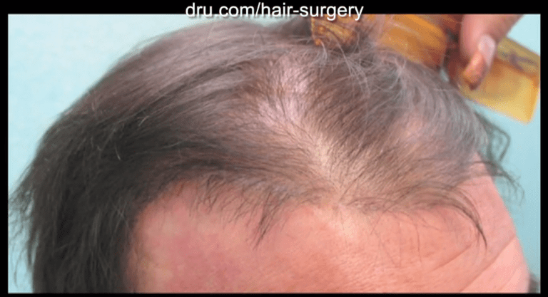 Hair flap surgery through the Juri flap method produced hairs that grew in the opposite growth direction