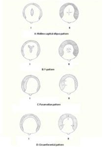 Common excisions used in scalp reduction surgery (alopecia reduction)