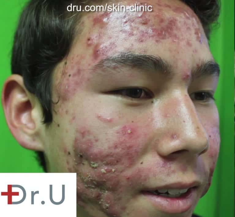  Los Angeles teen seeking treatment for his acne as well as a way to get rid of acne scars.