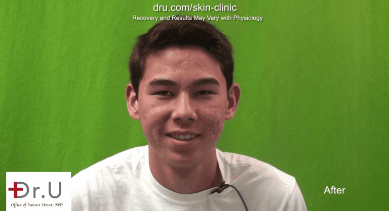 This Los Angeles patient's quest to get rid of acne scars was a success thanks to the two step process that started with photodynamic therapy for acne 