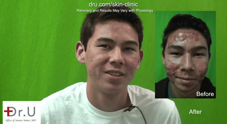 This patient's parents approached a medical dermatologist to treat their son's severe acne*
