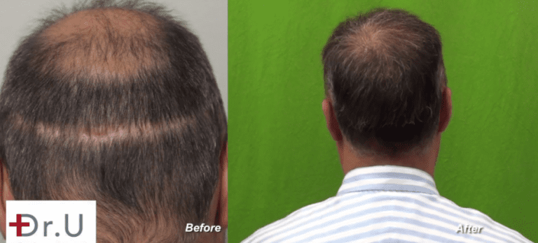 Results of  the Dr.UGraft™ hair repair to cover strip scar