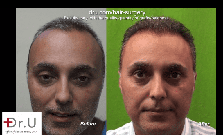 Front view of patient who underwent a face to head hair transplant with Dr. Umar for to fix his unsuccessful hair transplant from a previous strip surgery clinic 