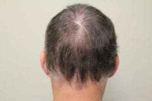 An elevated neckline can result from scalp reduction procedures