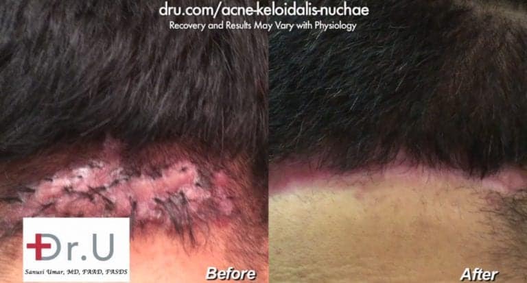 The best treatment for acne keloidalis nuchae shown through close up views before and after patient's removal surgery