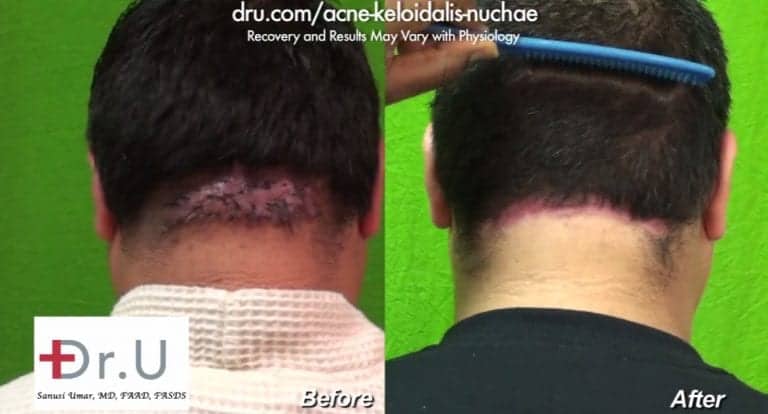 AKN Patient Before and After His Surgical Remedy for AKN Bumps