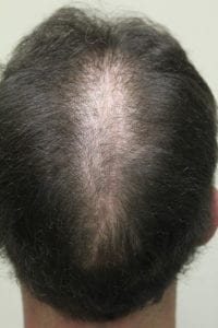 Photo shows a vertical linear scar where the edges of the patient's scalp reduction procedure were closed. However, hair loss continued to progress around these edges creating a visible slot.