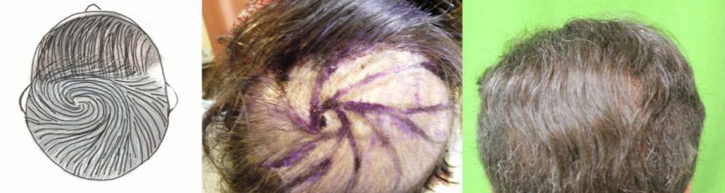 Hair flap surgery repair of abnormal hair growth direction and crown baldness
