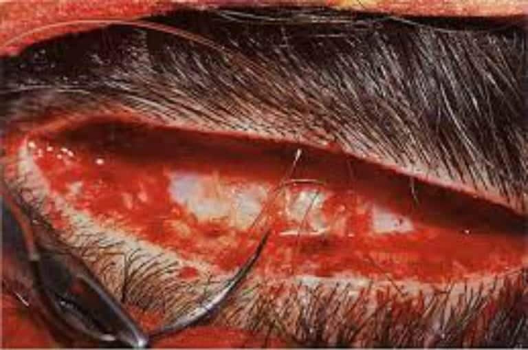 The length of the resulting strip hair transplant (FUSS) wound often extends from ear to ear in many patient cases