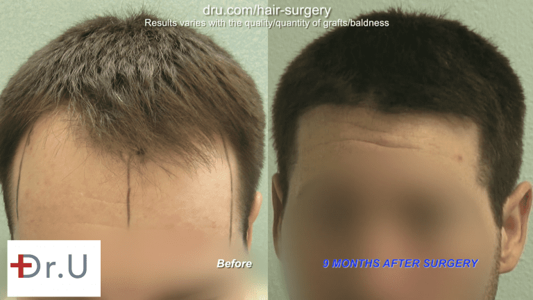 Dr. U constructed an aggressive, natural looking hairline for this patient which reduced the size of his forehead. 3,200 grafts were extracted from the nape in this FUE hairline restoration