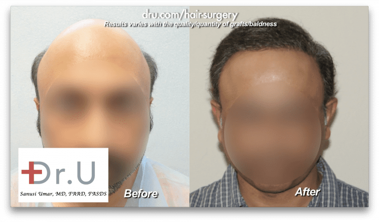 This patient experiencing severe baldness wanted a mature natural looking hairline, in addition to coverage on his top and crown. Using his Dr. UPunch Rotor to augment the patient's donor supply, Dr. U was able to extract 8,000 grafts from the patient's head and 4,000 from his beard over the course of 2 surgeries, 1 year apart.