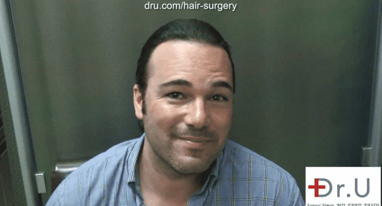 Beverly Hills patient shown two year after his hairline reconstruction using leg hair