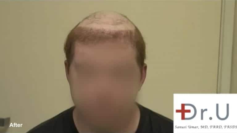 Since his traditional donor area was depleted due to previous surgeries at other clinics, Dr. U extracted grafts from the chest, stomach, and beard. By using body hair, Dr. U was able to provide the patient with a natural looking hairline to be integrated with the patient's hair piece. 