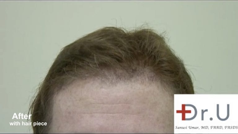 Using his advanced FUE UGraft system, Dr. U created temple points to be more in line with the patient's hair piece, creating a smooth integration between a natural looking hairline and toupee.