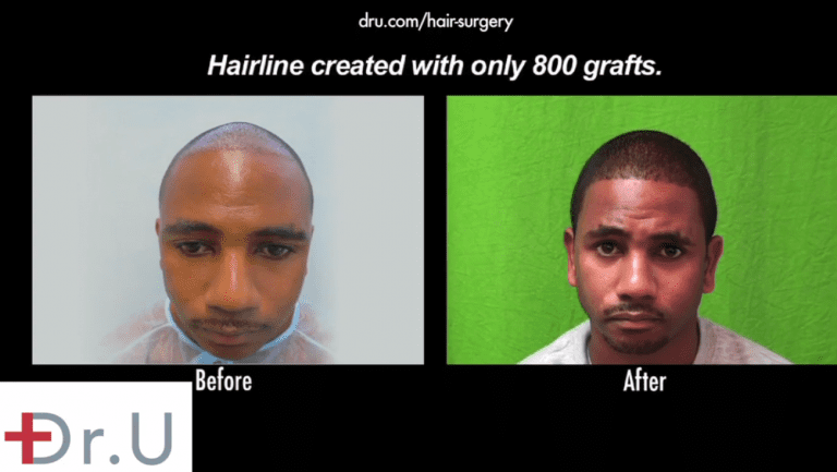 FUE hair transplantation for African Americans can produce amazing coverage if the grafts are safely and successfully harvested. Advanced tools like the Dr.UPunch Curl ™ allow this type of reliable growth to become possible