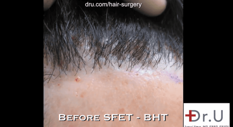 Patient before his procedure with Dr. Umar to reverse poor hairline restoration results. Hairline shows obvious looking plugs due to the use of large sized punches