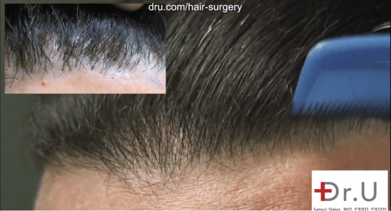 Before and after photos showing a successful outcome to correct the patient's pluggy hairline using leg hair