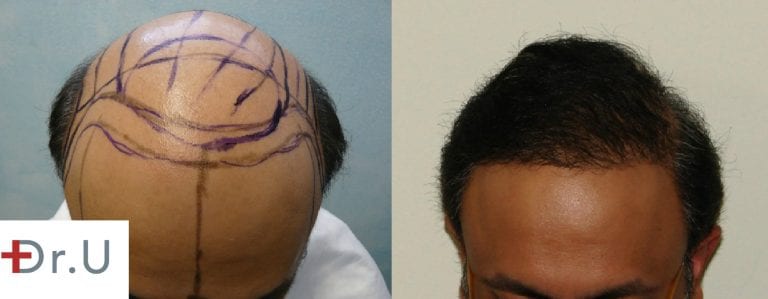 This severely bald, Norwood 7 patient was able to achieve comprehensive coverage for both the hairline and the crown due to the use of body hair grafts harvested with the Dr.UPunch intelligent 