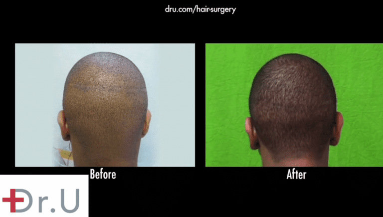 hair loss in black men should be addressed with advanced FUE performed with tools like the Dr.UPunch Curl™ to avoid the creation of linear strip scars. However, with the right FUE procedures, it is possible to insert hair follicle grafts into the scar tissue to render it less visible, enabling successful hair transplant repair in African American individuals 