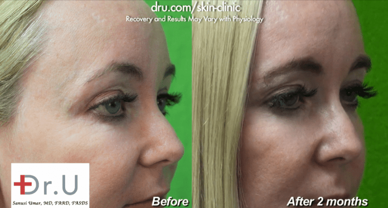 Botox was used as a crows feet treatment to improve the appearance of minor lines around the patient's eyes and to prevent existing wrinkles in this area from becoming deeper