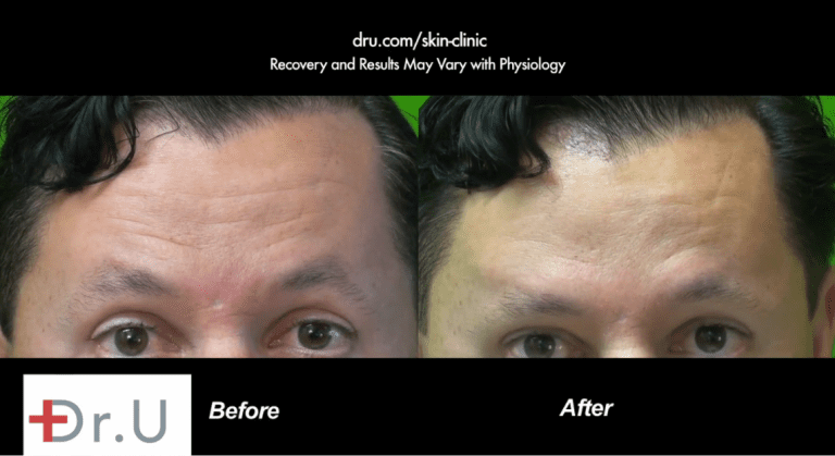 Dysport was used to improve the appearance of forehead lines on this patient's forehead. These before and after photos show a fewer number of wrinkles and a smoother looking forehead