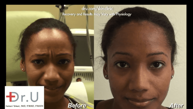 Dr. Umar's patient shows intense muscle contraction between her brows. Dysport did an amazing job to get rid of the frown lines in this area which transformed her facial expression.