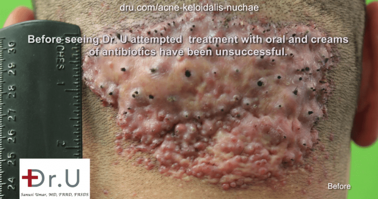 This patient suffered from a large barber's rash on the back of the neck for many years.