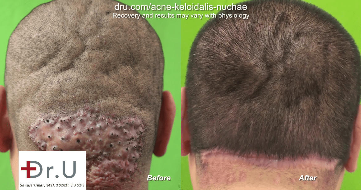 Using his surgical “Batman” excision, Dr. Umar was able to make the AKN razor bump go away for this patient with an advanced diagnosis.