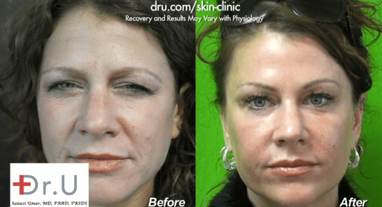 Redondo Beach patient is pleased with her natural looking lip augmentation outcome. This was achieved through a conservative use of filler and the thoughtful placement of the injections Redondo Beach patient is pleased with her natural looking lip augmentation outcome. This was achieved through a conservative use of filler and the thoughtful placement of the injections