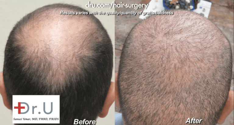 Patient who wanted to repair strip surgery mistakes showed continued baldness in the crown before his procedure with Dr. Umar. This area was successfully filled in using an expanded donor pool * Patient who wanted to repair strip surgery mistakes showed continued baldness in the crown before his procedure with Dr. Umar. This area was successfully filled in using an expanded donor pool